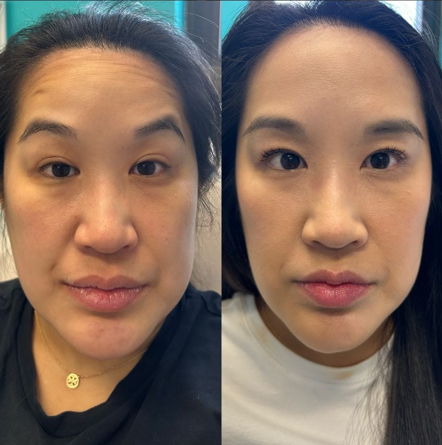 Professional Botox treatment in Timonium, Maryland