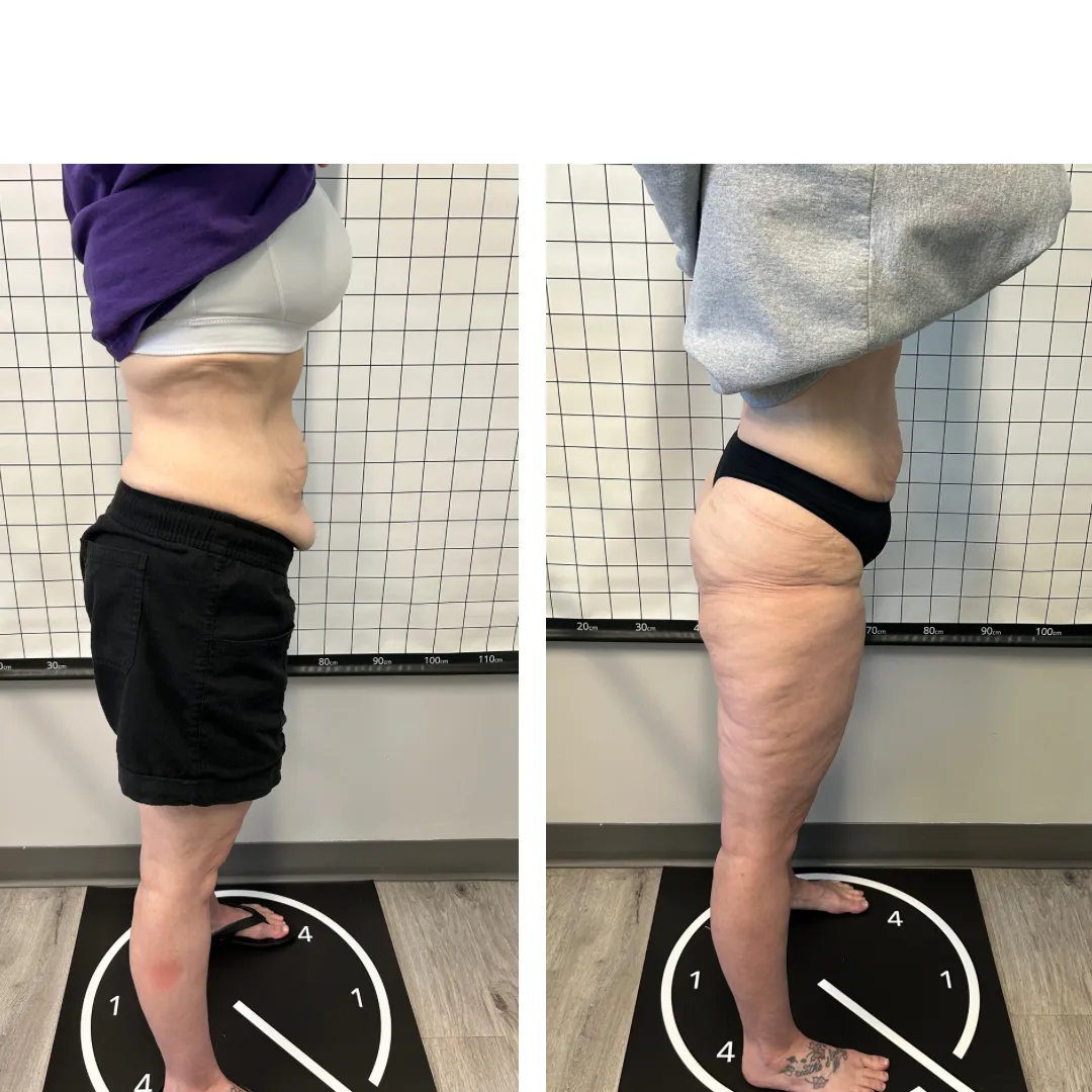 Visible fat reduction results from body sculpting in Timonium