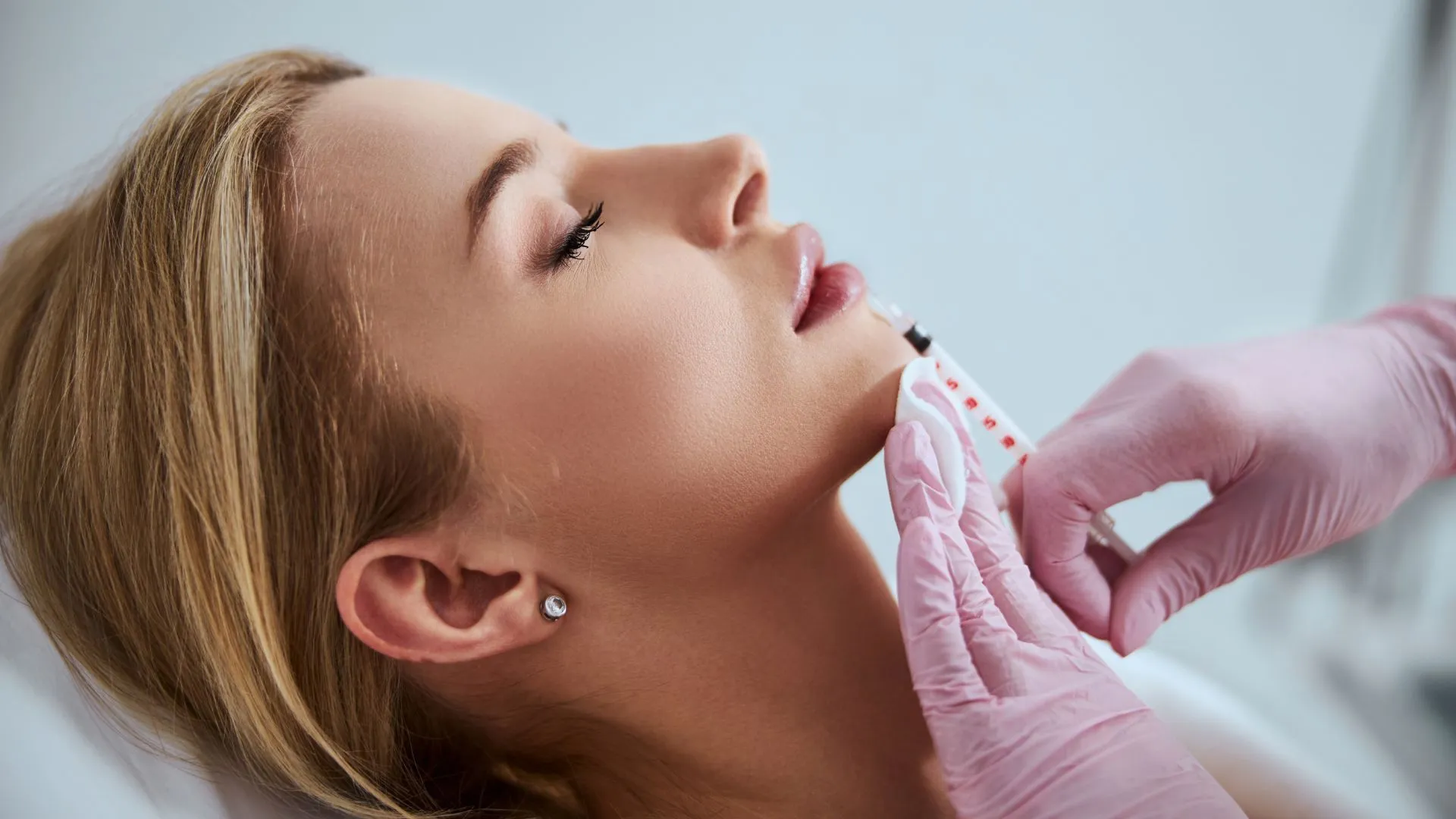 Full facial balancing with dermal fillers in Hunt Valley, Maryland