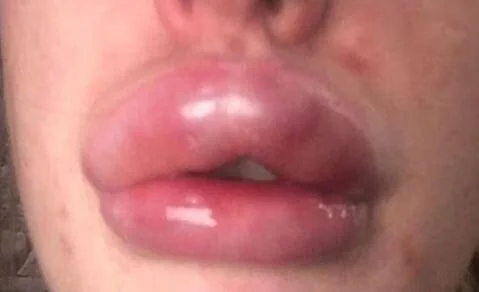 Close-up of overfilled lips illustrating duck lips, lip filler migration, and the importance of natural-looking lip filler near Baltimore City.