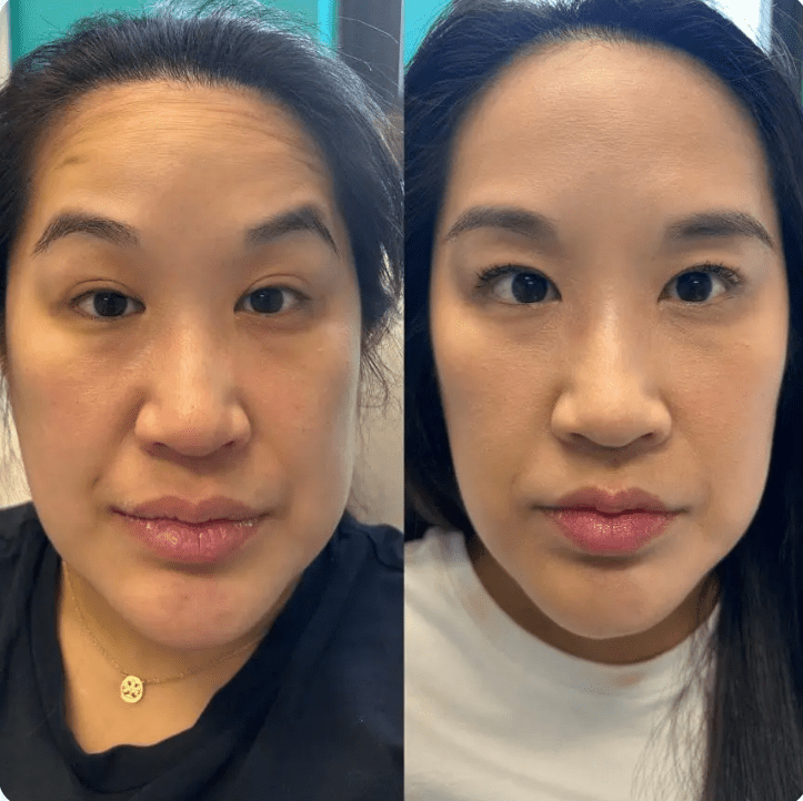 Botox Timonium Before and After