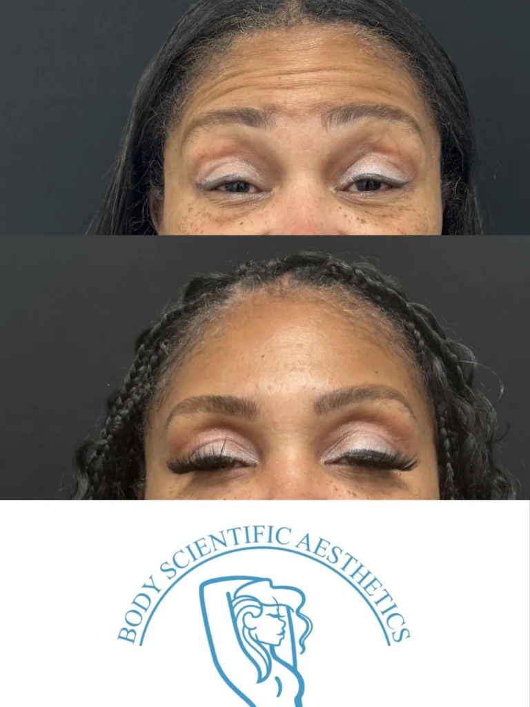 Picture depicting before and after with Wrinkle Prevention client
