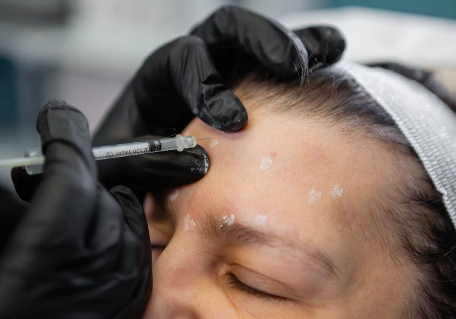 Close-up of a cosmetic procedure being done on a forehead.