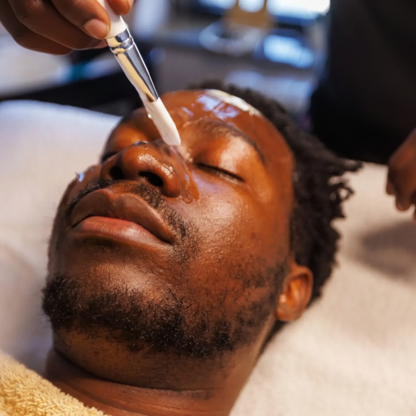 Male chemical peel for site