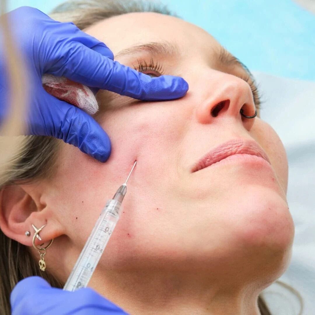 A woman receives a neuromodulator such as Botox at Body Scientific Aesthetics, a Nurse Practitioner–led medical aesthetics practice in Timonium, Maryland. Each Botox appointment includes an evaluation of facial anatomy, muscle movement, treatment goals, and the areas of concern. The treatment may help reduce the appearance of forehead lines, frown lines, crow’s feet, and other expression wrinkles while preserving natural-looking facial movement. Body Scientific Aesthetics serves patients searching for Botox near them throughout Baltimore County, including Timonium, Towson, Cockeysville, Hunt Valley, Parkville, Perry Hall, White Marsh, Pikesville, Owings Mills, and surrounding communities.